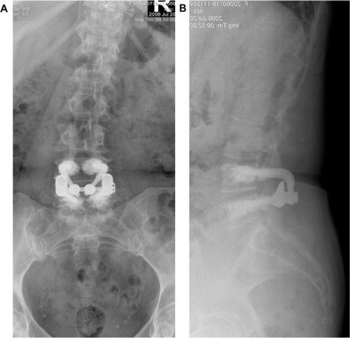 Figure 6 Lumbar X-rays with the new implant (anteroposterior and lateral standing).