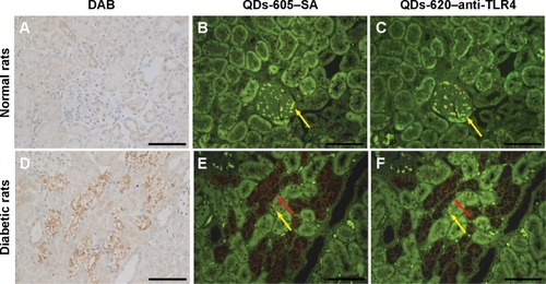 Figure 5 Distribution of Toll-like receptor 4 (TLR4) protein in the renal tissues of (A–C) normal rats and (D–F) diabetic rats identified with immunohistochemistry (IHC) and quantum dot (QD)-IHC. The column on the left displays 3,3′-diaminobenzidine (DAB) staining, the middle column shows TLR4 stained by quantum dots with the emission wavelength of 605 nm conjugated to streptavidin (QDs-605–SA), and the column on the right shows TLR4 stained by CdSe/CdS/ZnS quantum dots with the emission wavelength of 620 nm (QDs-620)–anti-TLR4 conjugates. TLR4 protein localization patterns were the same when detected by the three staining methods. The middle and right columns were excited by blue light. The green background in (B, C, E, and F) is tissue autofluorescence (yellow arrows) and the red signal is QD fluorescence (red arrows).Note: Scale bars: 100 μm.
