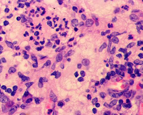 Figure 3 Highly magnified (400×) microscopic image shows emperipolesis.
