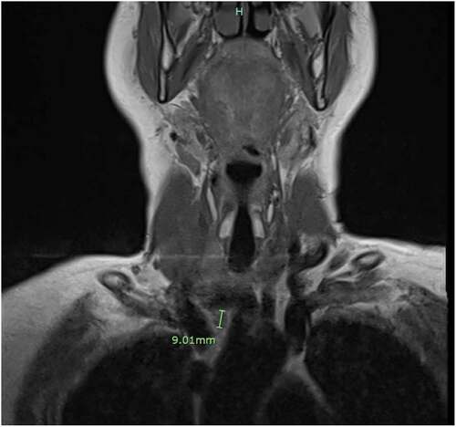 Figure 1. Showing enhancing nodule in the right superior mediastinum between the superior vena cava and brachiocephalic artery