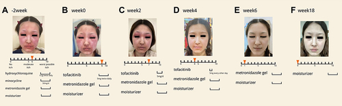 Figure 1 Changes of skin lesions and itching scale during tofacitinib treatment.(A) Image of skin lesions and itching scale before patient started oral tofacitinib. (B) Image of skin lesions and itching scale when patient started oral tofacitinib. (C–E) Images of skin lesions and itching scale at week 2,4,6. (F) Image of skin lesions and itching scale at week 18.