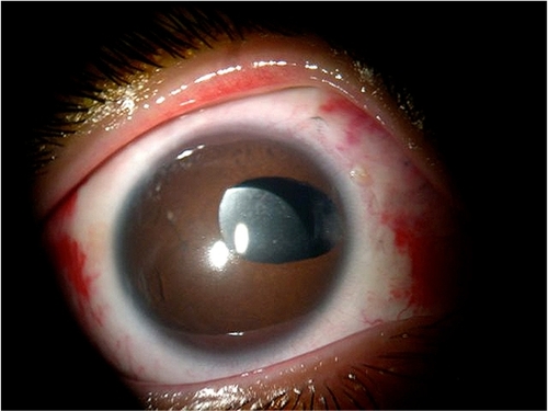 Figure 2 Dislocation of intraocular lens.