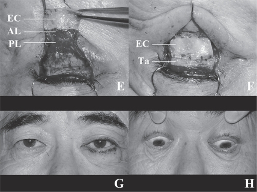 Figure 1 Figure 1A A 3-mm left lower eyelid retraction caused by previous surgery for a squint (inferior rectus muscle recession) is shown.Figure 1B The anterior surface of the lower eyelid retractors is shown. Part of the Lockwood ligament can be seen.Figure 1C The posterior surface of the lower eyelid retractors is shown. The double layers of the retractors can be clearly discerned. The posterior layer of the lower eyelid retractors is always shorter than the anterior layer.Figure 1D The lateral and medial horns of the lower eyelid retractors are incised at the width of 17 mm.Figure 1E The harvested auricular cartilage is interposed between the lower edge of the tarsus and the distal edge of the anterior layer of the lower eyelid retractors while the posterior layer remains unfixed to any structure. The volume of the harvested cartilage for the retraction patients is twice the retraction from the lower corneal limbus with 1 mm of extra volume in the proximal and distal margins, respectively, for sutures. The height of the harvested cartilage for the entropion patients is 4 mm (horizontal length in both groups is always constant at 17 mm).Figure 1F The cartilage is fixed with 5 sutures on each of the distal and proximal sides. The suture on the right upper edge is masked by the recessed anterior layer of the lower eyelid retractors in this image.Figure 1G Sufficient elevation of the lower eyelid is shown. The skin is sutured with interrupted 6–0 nylon sutures.Figure 1H The rehabilitated left lower eyelid moves down sufficiently during a downward gaze.Figure 1I The contour of the left lower eyelid is within the permissible range.