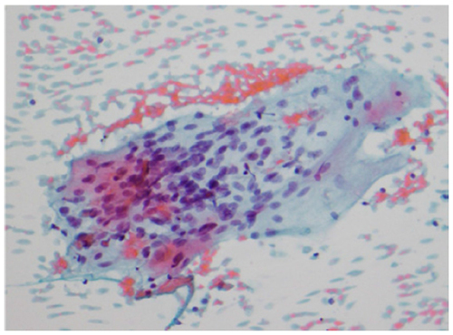 Figure 4 Endobronchial guided fine-needle aspirate of lymph node with clusters of epithelioid histiocytes with associated smeared lymphocytes, a feature of nonnecrotizing granulomas.