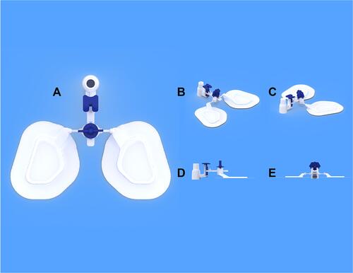 Figure 2 Specialized 3D graphic design of the end of the DYNAtraq device. (A) Frontal plane view; (B and C) obliquus plane view; (D) sagittal plane view; (E) axial plane view.