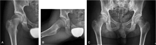 Figure 2. Case 2. A and B. Marked coalescence and almost absent anterior head-neck offset on standard AP (A) and Lauenstein (B) views at 14 years of age. C. AP pelvic view at 16 years of age.