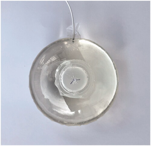 Figure 2. The balloon is filled through a catheter which can subsequently be dislodged. A self-opening valve will empty the balloon after 16 weeks.
