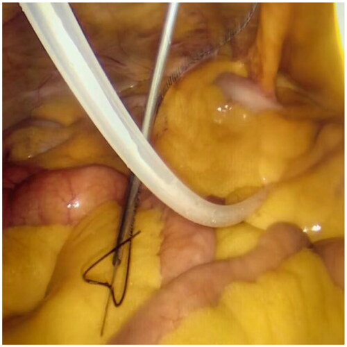 Figure 2. Ssuture passer with a NO. 7 suture was inserted into the 1 mm small incision (The left side is the head).