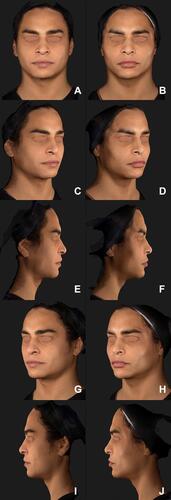 Figure 5 Case #2: Images taken with Vectra Software at baseline (A, C, E, G and I) and after 60 days of the first treatment session with Vectra Software (B, D, F, H and J).