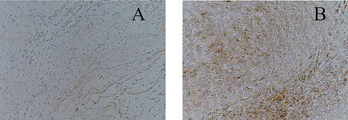 Figure 2 PD-L1 expression in CRC resection samples (IHC, ×400).