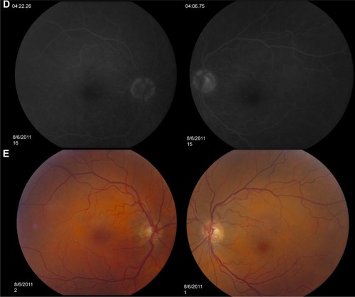 Figure 6 Fundus photos and FA studies of Case 3.