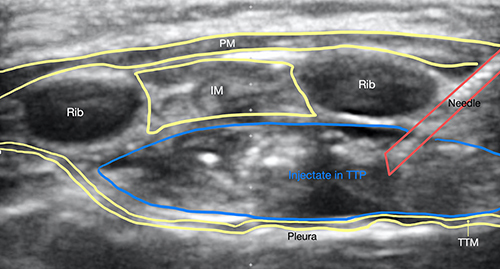 Figure 3 Injectate placed superficial to the transversus thoracic muscle (TTM) in the transversus thoracic plane (TTP), with the needle under direct guidance passing through the pectoralis muscle (PM) and intercostal muscle (IM).
