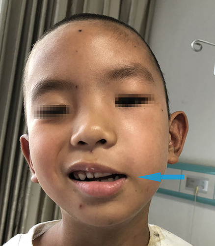 Figure 2 Before facial paralysis treatment (The arrow here indicate facial nerve injury, as shown by the crooked corners of the mouth).