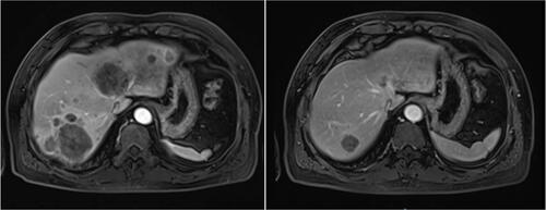 Figure 2 MRI scan results of change in target lesions in liver metastasis of one patient with metastatic colorectal cancer after treatment with regorafenib.
