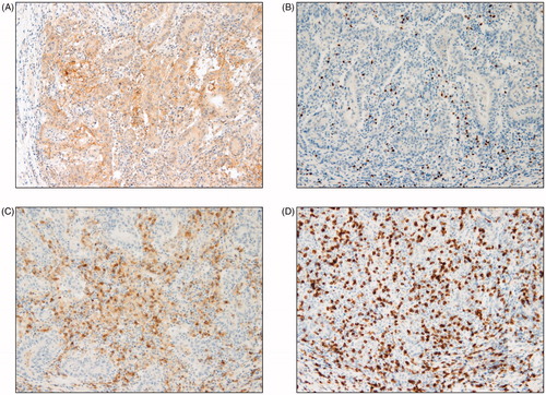 Figure 1. Representative examples of immunohistochemical findings of intraepithelial infiltrating lymphocytes. Microsatellite instability high PD-L1 expression (A) CD4+ T cells (B), CD8+ T cells (C), FOXP3+ T cells (D) (magnification × 400).