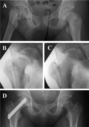 A. Severe SCFE on the right side, with the femoral head displaced posterior and medial to the femoral neck. B. Improved alignment and wide separation of the upper femoral epiphysis after gentle longitudinal traction. C. Perfect alignment without residual slip of the upper femoral epiphysis after gentle longitudinal traction and internal rotation. D. After 2 years, there was no osteonecrosis or contralateral SCFE.