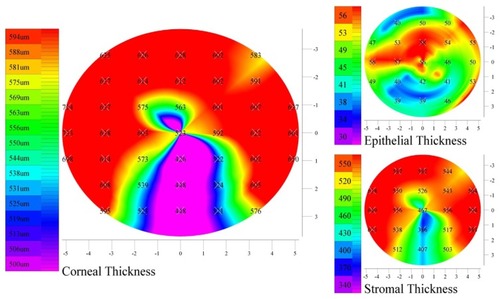 Figure 9 Example of localized thin epithelium (lower segment), over an area of a significantly thinner stroma.