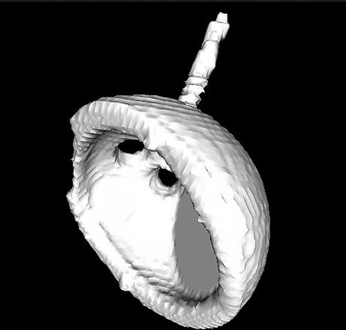 Figure 1. An acetabular cup surface model obtained after segmentation of CT pelvic images. To eliminate metallic artifacts, the intensity threshold was set at a level where only the cup was selected.