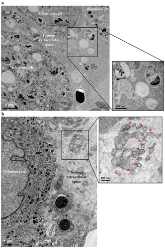 Figure 3. Electron microscopy analysis of extracellular vesicles in metastatic melanoma tissues. (a) High-pressure frozen melanoma thin section. Melanin accumulation in the cells is clearly evident. The higher magnification image shows different types of vesicles in the extracellular space. N = 1. (b) Melanoma thin section prepared by chemical fixation. A large tumour cell and two lymphocytes are shown. Black stain, possibly melanin, is clearly visible inside the melanoma cells, and the melanoma cells are well recognized by their cell membrane. The higher magnification image shows EVs (red arrows) in the extracellular space. N = 2.