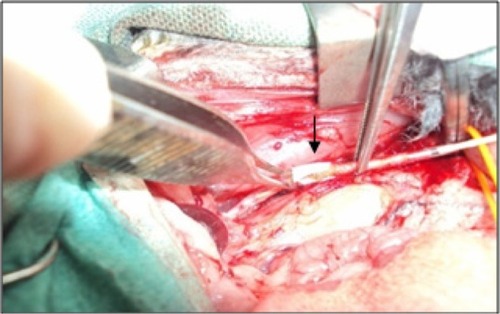 Figure 3 Intraoperative view of sutureless vascular anastomosis by glued prosthesis in rabbit (black arrow).