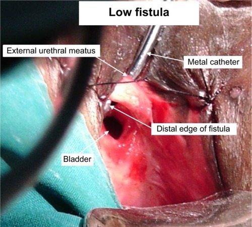 Figure 1 Intraoperative photograph showing a typical low fistula at the start of surgery.