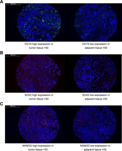 Figure 1 OCT4, SOX2, and NANOG expressions in tumor tissues and paired adjacent normal tissues.