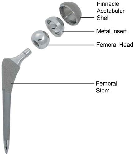 Figure 1. The Pinnacle Hip System (PHS). The PHS has four components: The shell or cup (Bantam®, Primary®, Duofix®, and Revision®); a liner made from Co-Cr-MO (Ultamet®, Ultamet XL®), polyethylene (Marathon® and Altrx®) or alumina ceramic (Biolox® Delta); a stem made from titanium (C-Stem®, Corail®, AML®, Endurance®, Prodigy®, Replica®, S-Rom®, Summit Duofix®, Summit Porocoat®, Summit Stem Cemented®); and a head made of Co-Cr-MO (M-Spec®, aSphere®) or alumina ceramic (Biolox® Delta).