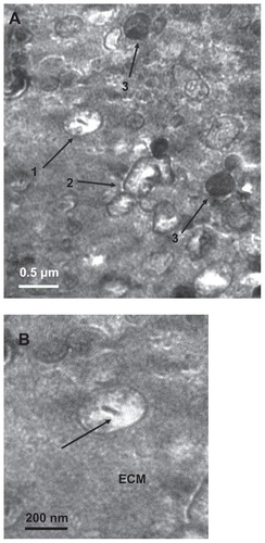 Figure 1 Transmission electron micrograph of calcifying nanoparticles. (A) Calcifying nanoparticles between 50 nm to 500 nm in diameter showing different electron-dense shells in calcified placental tissues. (B) Nucleic acid-like materials distributed within the individual calcifying nanoparticles in the extracellular matrix. (C) A calcifying nanoparticle self-divided into two. (D) Calcifying nanoparticles with thin shells exiting placental villus. (E) Single calcifying nanoparticles among hydroxyapatite crystals in calcified placental tissues.Note: Bar indicates magnification of 200 nm.