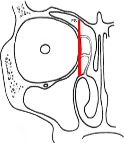 Figure 3 CSFR involved in the frontal posterior table can be classified into two types based on their relationship with the plane of the lamina papyracea (red line).