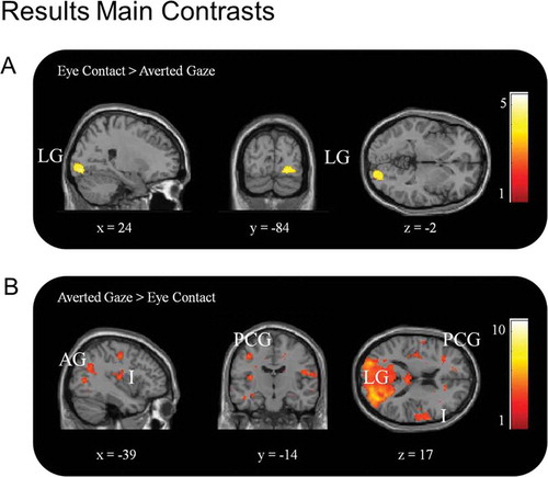 Figure 3. A. Differences in BOLD response for faces depicting eye contact vs. averted gaze. Activation was revealed in right lingual gyrus (LG) (p < .005, k > 60). B. Differences in BOLD response for faces depicting averted gaze vs. eye contact. Activation was revealed, amongst other areas, in lingual gyrus (LG), bilateral insula (I), and left precentral gyrus (PCG) (p < .005, k > 60).