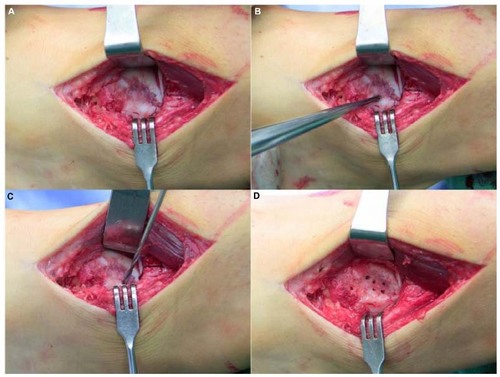 Figure 2 Open exposure of a large medial talus osteochondral lesion (A), followed by curettage to expose subchondral bone (B), drilling to perforate the subchondral bone (C), final appearance prior to closure (D).