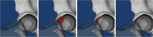 Figure 2. A 3D model of the pelvis for each simulation method is shown (from left to right: the Equidistant, Simple, Constrained and Translated methods). The femur has been rendered translucent for better visualization of the detected impingement zones at the acetabulum, which are colored red. The manually digitized impingement zones are shown by the yellow superimposed dots. The different properties of the methods regarding detection of location and size of impingement area are depicted, and the relation of the digitized point to the impingement area becomes apparent.