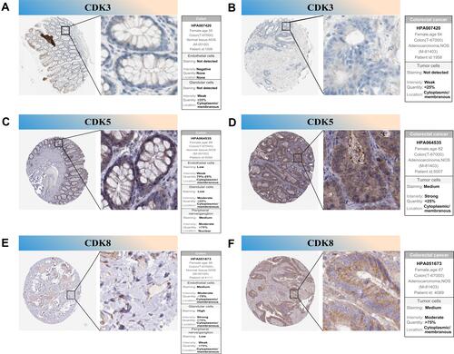 Figure 9 IHC analysis of CDK3, CDK5 and CDK8 with prognostic values. (A–F) Differentially expressed proteins of CDK3, CDK5 and CDK8 with prognostic values in colorectal normal tissues and colorectal cancer in The Human Protein Atlas database.