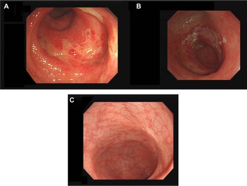 Figure 1 Endoscopic findings.