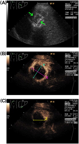 Figure 2. Grey-scale and contrast-enhanced ultrasound of microwave ablation area after the 50 W-5 min protocol. (a) Grey-scale ultrasonography image showing a hyperechoic nodule. (b) Illustration of the X- and Y-axes of the contrast-enhanced ultrasonography image. (c) Illustration of Z-axis on a contrast-enhanced ultrasound image.