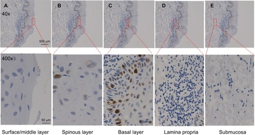 Figure 2 p53 expression pattern in oral epithelial mucosa.Notes: (A) Surface/middle layer. (B) Spinous layer. (C) Basal layer. (D) Lamina propria. (E) Submucosa. Scale bar: 500 μm (40×), 50 μm (400×).