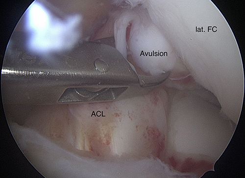 Figure 3 Arthroscopy, notch; ACL avulsion.