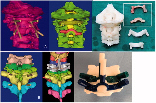 Figure 3. The planned screw trajectories of C1 (A) and C2 (B). Postoperative CT demonstrated that the trajectory deviations were 0.3 mm at the left C5 pedicle, 0.2 mm at the right C5(C), 0.1 mm at the right C6, and 0.4 mm at the left C6 (D). They were accurately at the planned location (class 1) and within the pedicle cortex (grade 0) (the mask in A and B reveals the C5 and C6 after reduction as we simulate on the computer).