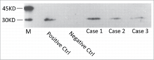 FIGURE 1. Western blot analysis of protein 14-3-3 in CSF samples. Positive Ctrl: 10% goat brain homogenate. Negative Ctrl: a human CSF sample previously confirmed to be 14-3-3 negative. Case sample: the CSF samples of the E196A gCJD cases. M: commercially supplied prestained protein molecular markers whose relative molecular weights are showed on the left.