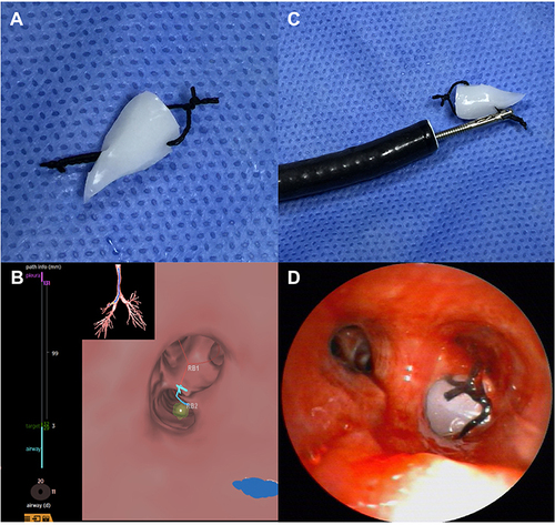 Figure 1 Procedure of the bronchoscopic silicone plug placement. (A) The customized silicone plug which we used in the study. (B) Preoperative planning was designed via the virtual bronchoscopic navigation system. (C) The tip knot of the plug was grasped by the grasping forceps to guide the route and adjust orientation. (D) The silicone plug was placed into the targeted bronchi by flexible bronchoscopy.