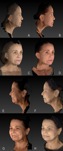 Figure 3 Relax and Firmness technique before and 90 days after in maximum platysma muscle contraction. Clinical case 1: (A) before in profile position, (B) after in profile position, (C) before ¾, (D) after ¾); Clinical case 2: (E) before in profile; (F) after in profile, (G) before ¾, (H) after ¾).