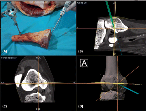 Figure 5. The accuracy of the technique was also validated with the help of a CT-based navigation system. (A) After bone resection with the aid of the surgical jig, the resected bone segment with the attached reference tracker still retained the image-to-bone registration and was used for the validation. When the navigation pointer was in contact with the resected distal bone end, the virtual tip of the pointer (the orange cross) was compared with the planned resection plane (shown in yellow) on the navigation display. The coronal (B) and sagittal (C) images and the 3D bone model (D) showed the achieved resection to differ by <1 mm from the planned resection. This suggested that the technique could help execute the preoperative planning accurately in the surgical field.