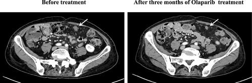 Figure 2 CT images of peritoneal metastasis before and after Olaparib treatment (white arrows: peritoneal metastases).