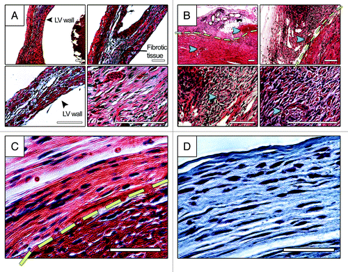 Figure 2. Histology analysis of infarcted mouse hearts with no treatment (A) and treated with patch (B-D), four weeks post implantation. (A) and (B) show HE staining of heart sections at four different magnifications. (C) and (D) show HE and trichrome staining of patch-treated heart sections, respectively. Extensive fibrosis can be seen in MI heart with no treatment. Endogenous cardiac cells migrated to the patch and, in some sections, aligned themselves with collagen fibrils, (C)and(D). Yellow line in panels (B) and (C) demonstrate the approximate boundary between the patch and the host tissue. Green arrows point to the blood vessel with blood stream inside the patch and at the border zone. Blue arrows show the suture spot within the patch which has been replaced by cellularized tissue. Scale bars in panels (A) and (B) are 100 µm. Scale bars in panels (C) and (D) are 50 µm.