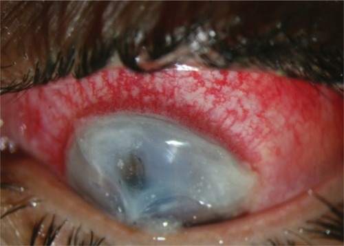 Figure 1 Left eye at presentation (down gaze).