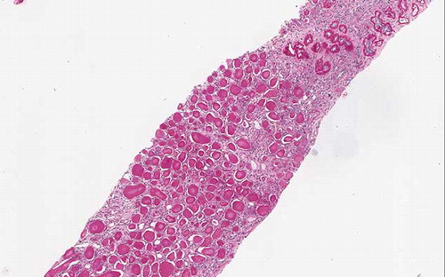 Figure 2. Atrophic dilated tubules filled with hyaline casts (thyroidization) PAS 60×.