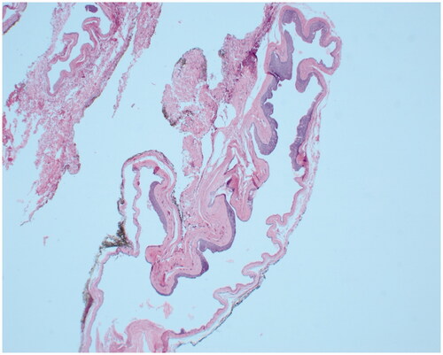 Figure 3. Low power micrograph of the lesion shows an extensive cystic component.