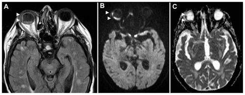 Figure 2 FLAIR axial image (A) depicts high signal in the right vitreous (arrowheads) suggestive of subchoroidal effusion. Note low signal in normal vitreous on the left due to fluid suppression. DWI sequence (B) and corresponding ADC map (C) demonstrate restricted diffusion (bright signal) within the vitreous chamber on the right and confirms a subchoroidal abscess (arrowheads).The mean ADC value in the subchoroidal abscess was 602 × 10−6 mm2/s, and in the central portion 2650 × 10−6 mm2/s. The left globe was normal, with a mean ADC of 2737 × 10−6 mm2/s.