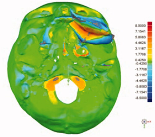 Figure 7. Color map of pre- and post-operative maxilla models showed deviation between result and preoperative plan.