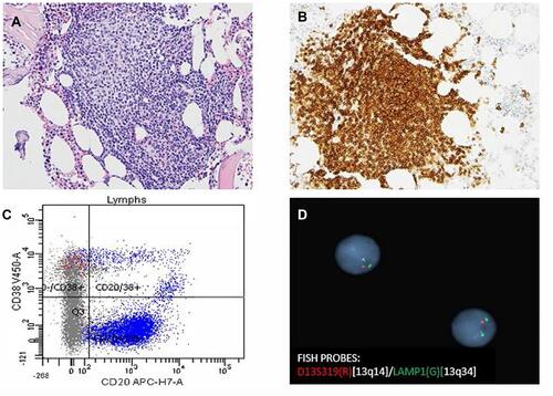 Figure 1 The bone marrow biopsy showed nodular proliferation of neoplastic lymphocytes (A, H&E x 20). Immunohistochemistry revealed the lymphocytes positive for CD23 (B, x 20). Flow cytometry analysis confirmed lymphocytes positive for CD20 and predominantly negative for CD38 (C). FISH study revealed loss ofD13S319 signal, which indicated the deletion of 13q (D).